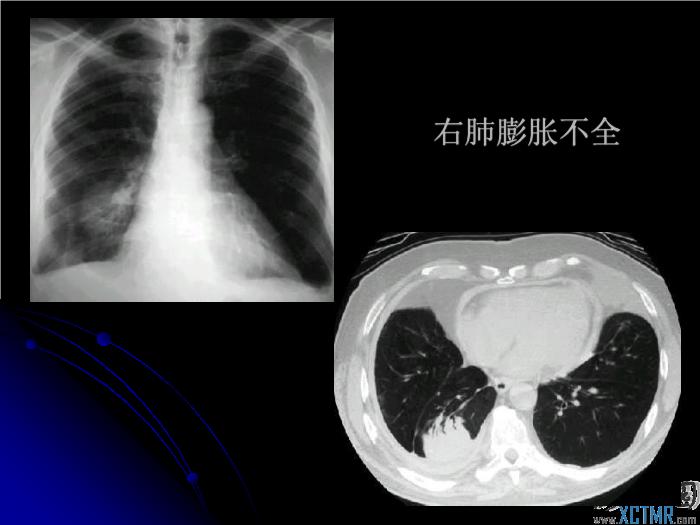 【醫學PPT課件】肺先天性疾病影像診斷_PPT課件第6頁