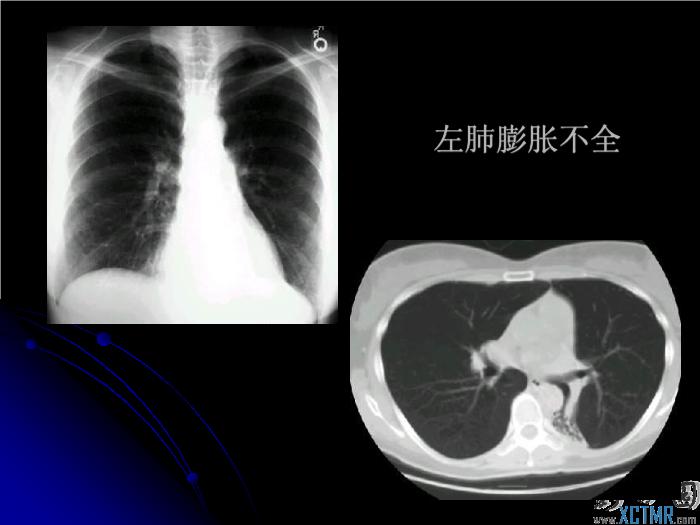 【醫學PPT課件】肺先天性疾病影像診斷_PPT課件第7頁