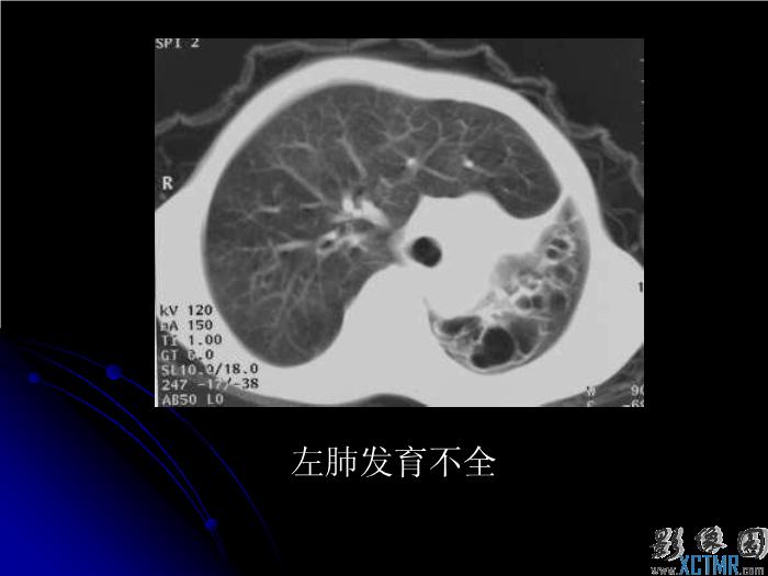 【醫學PPT課件】肺先天性疾病影像診斷_PPT課件第8頁