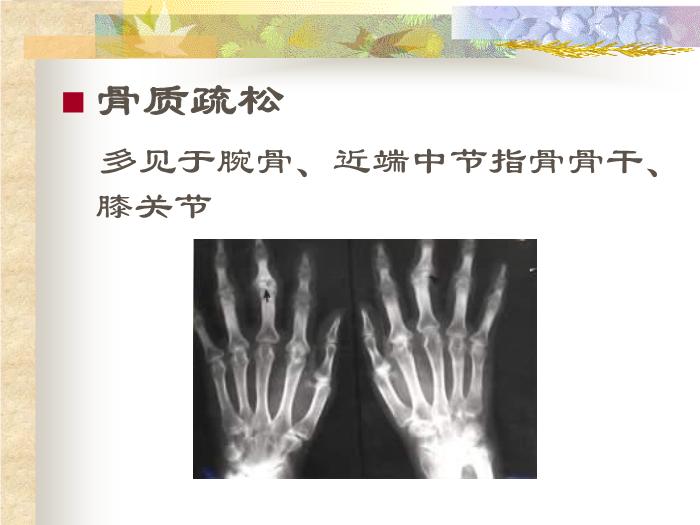 【醫學PPT課件】關節影像學診斷_PPT課件第15頁
