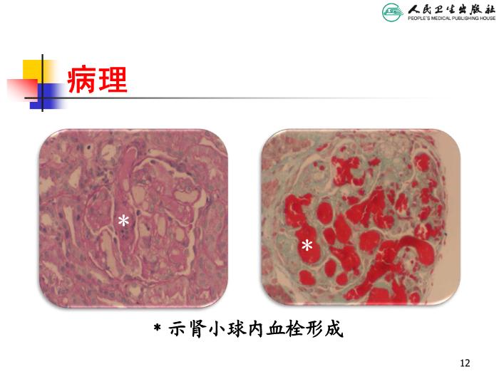 【醫學PPT課件】溶血尿毒綜合征 人衛版教學PPT課件第12頁