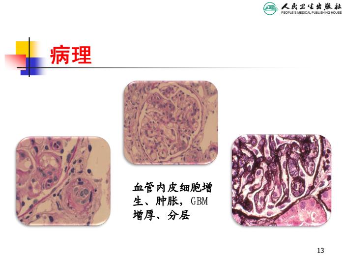 【醫學PPT課件】溶血尿毒綜合征 人衛版教學PPT課件第13頁