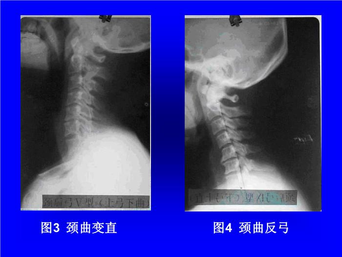 【醫學PPT課件】頸曲與胸椎關系X線片測量分析-頸椎病病因探討之一 第10頁