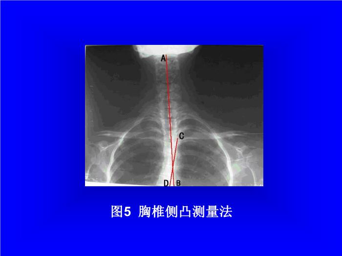 【醫學PPT課件】頸曲與胸椎關系X線片測量分析-頸椎病病因探討之一 第12頁