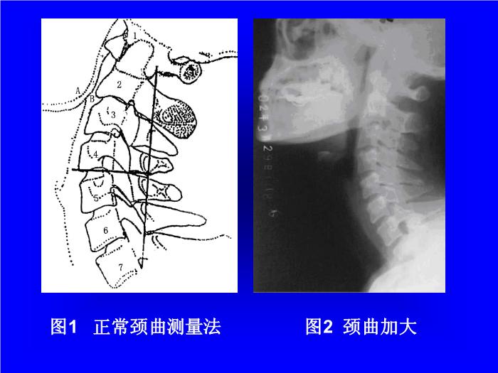 【醫學PPT課件】頸曲與胸椎關系X線片測量分析-頸椎病病因探討之一 第9頁