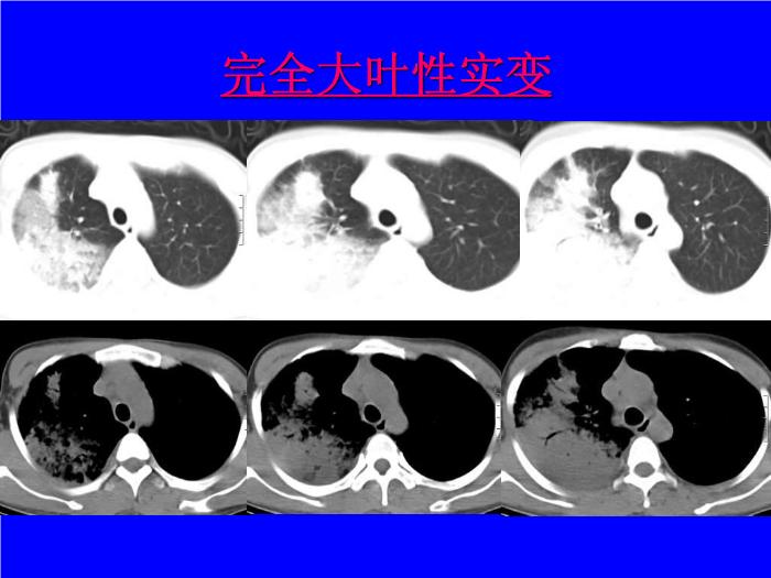 【醫學PPT課件】肺炎的影像學診斷 南昌大學第一附屬醫院第10頁