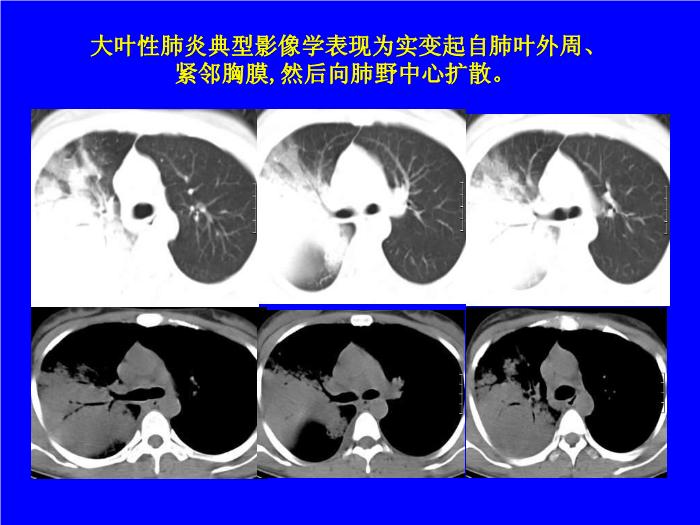 【醫學PPT課件】肺炎的影像學診斷 南昌大學第一附屬醫院第11頁
