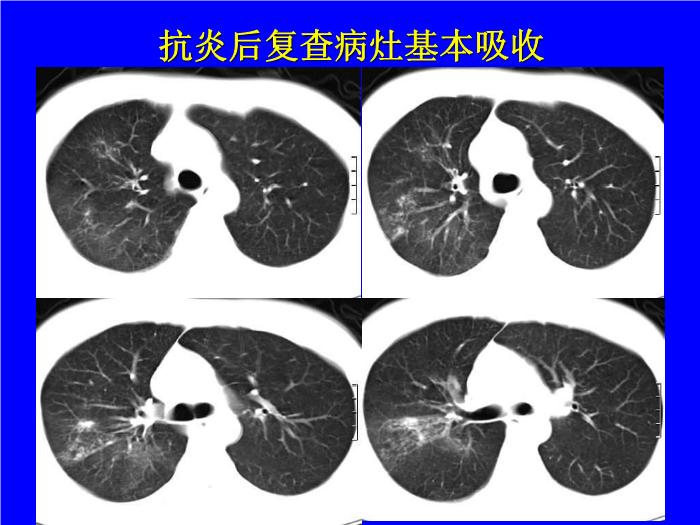 【醫學PPT課件】肺炎的影像學診斷 南昌大學第一附屬醫院第12頁