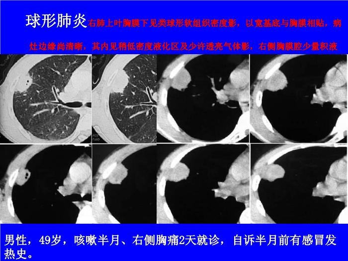 【醫學PPT課件】肺炎的影像學診斷 南昌大學第一附屬醫院第14頁