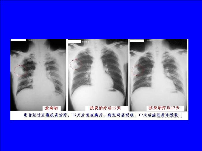 【醫學PPT課件】肺炎的影像學診斷 南昌大學第一附屬醫院第15頁