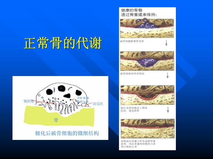 【醫學PPT課件】骨質疏松癥 重慶醫科大學附屬一院骨科第11頁