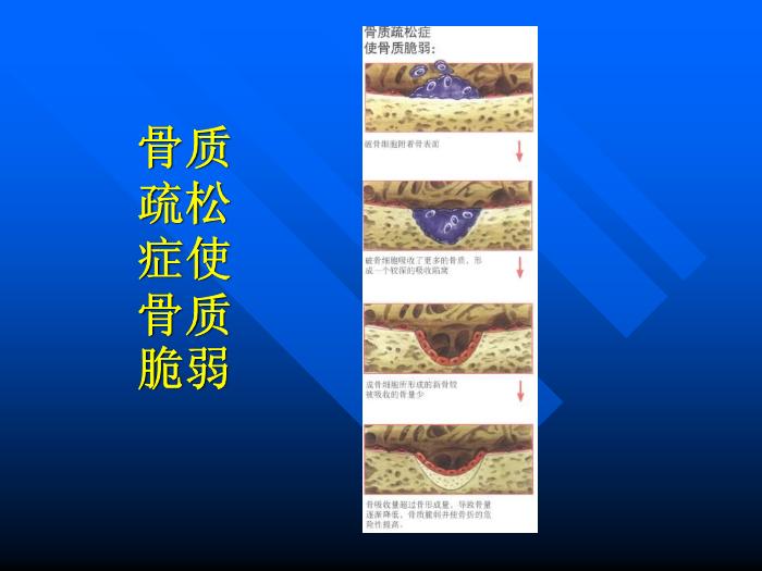 【醫學PPT課件】骨質疏松癥 重慶醫科大學附屬一院骨科第12頁