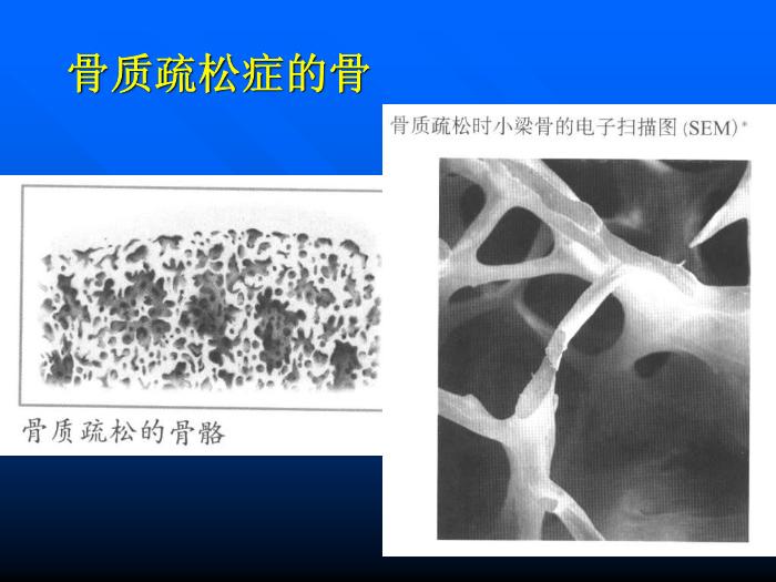 【醫學PPT課件】骨質疏松癥 重慶醫科大學附屬一院骨科第9頁