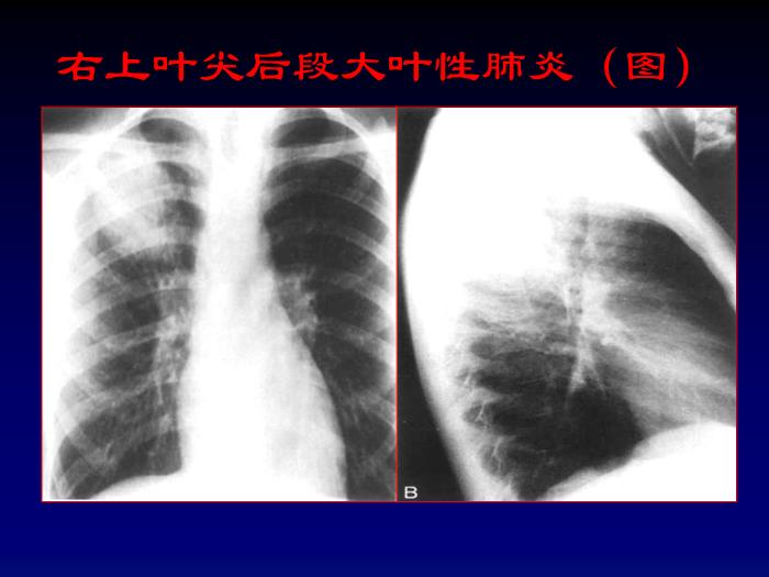 【醫學PPT課件】肺部炎癥影像診斷-第七節肺部炎癥_PPT課件第10頁