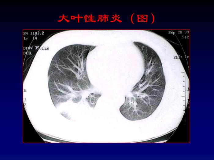 【醫學PPT課件】肺部炎癥影像診斷-第七節肺部炎癥_PPT課件第13頁