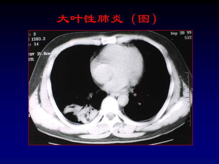 【醫學PPT課件】肺部炎癥影像診斷-第七節肺部炎癥_PPT課件第14頁