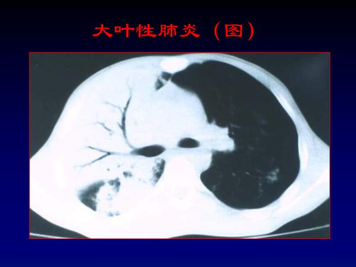 【醫學PPT課件】肺部炎癥影像診斷-第七節肺部炎癥_PPT課件第15頁