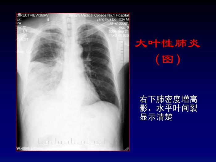 【醫學PPT課件】肺部炎癥影像診斷-第七節肺部炎癥_PPT課件第8頁