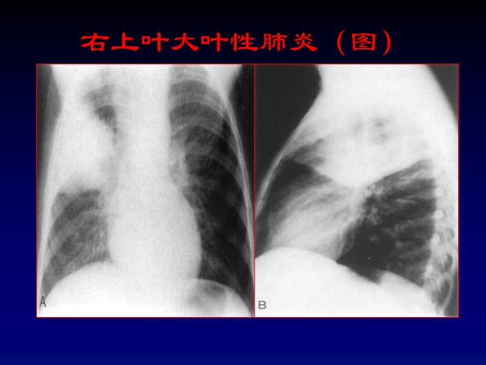 【醫學PPT課件】肺部炎癥影像診斷-第七節肺部炎癥_PPT課件第9頁