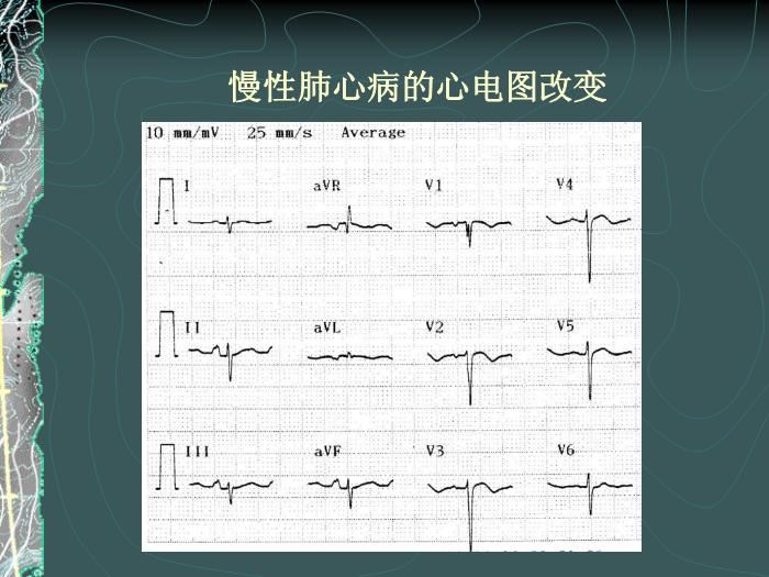 【醫學PPT課件】容中生-慢性肺源性心臟病-PPT課件預覽圖（11）