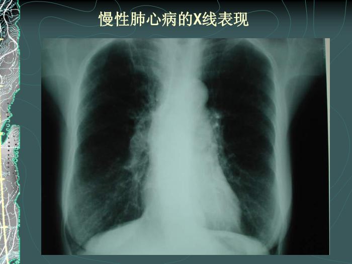 【醫學PPT課件】容中生-慢性肺源性心臟病-PPT課件預覽圖（9）