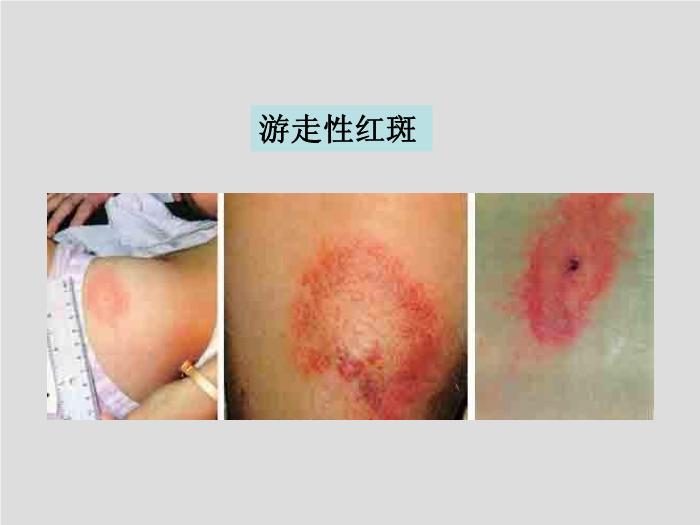 【醫學PPT課件】螺旋體 第三軍醫大學  汪正清第13頁